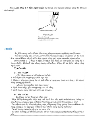 Khóa Khô khốc 1 + bấm Ngưu tuyền (là huyệt kinh nghiệm chuyên dùng trị khi bàn
chân sưng).
3.Bí tiểu
Là hiện tượng nước tiểu có đầy trong bàng quang nhưng không tự tiểu được.
Nếu tình trạng này kéo dài, nước tiểu ở bàng quang sẽ đi ngược lên bể thận,
đem theo vi khuẩn và gây viêm thận ngược dòng, gây nguy hiểm cho người bệnh.
Triệu chứng: 1 - 2 hoặc 3 ngày không đi tiểu được, có cảm giác tức vùng hạ vị
(bụng dưới). Muốn đi tiểu nhưng không tiểu được. Càng để lâu biến chứng càng
nguy hiểm.
Nguyên nhân
a- Theo YHHĐ:
- Tại bàng quang và niệu đạo, có thể do:
+ Tiền liệt tuyến sưng to gây chèn niệu đạo.
+ Khối u ở tiểu khung (ung thư cổ hoặc thân tử cung, ung thư trực tràng...) đè vào cổ
bàng quang gây bí tiểu.
- Do tổn thương thần kinh trung ương:
+ Bệnh ở tuy sống: gẫy xương sống, lao cột sống...
+ Bệnh ở não, màng não: não viêm, áp xe não...
b- Theo YHCT:
Bí tiểu có thể do 4 nguyên nhân sau:
. Thận khí bị thương tổn (thận hư), tinh huyết hao tổn, mệnh môn hỏa suy không khí
hóa được bàng quang gây ra bí tiểu (thường gặp nơi người lớn tuổi bị bí tiểu).
. Do thấp nhiệt ở hạ tiêu không hóa được, dồn xuống bàng quang làm cho khí cơ của
bàng quang bị trở ngại gây ra bí tiểu (thể nhiễm trùng đường tiết niệu).
. Do sỏi đường tiết niệu gây cản trở nước tiểu.
. Do chấn thương sau khi mổ làm cho khí cơ của bàng quang bị thương tổn gây ra bí
tiểu.
 