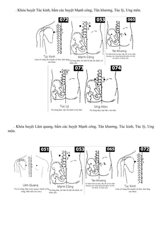. Khóa huyệt Túc kinh, bấm các huyệt Mạnh công, Tân khương, Túc lý, Ung môn.
. Khóa huyệt Lâm quang, bấm các huyệt Mạnh công, Tân khương, Túc kinh, Túc lý, Ung
môn.
 
