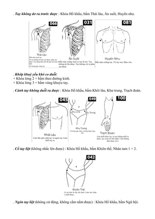 . Tay không dơ ra trước được : Khóa Hổ khẩu, bấm Thái lâu, Ấn suốt, Huyền nhu.
. Khớp khuỷ yếu khó co duỗi:
+ Khóa lóng 2 + bấm theo đường kinh.
+ Khóa lóng 3 + bấm vùng khuỷu tay.
. Cánh tay không duỗi ra được : Khóa Hổ khẩu, bấm Khôi lâu, Khư trung, Trạch đoán.
. Cổ tay liệt (không nhấc lên được) : Khóa Hổ khẩu, bấm Khiên thế, Nhân tam 1 + 2.
. Ngón tay liệt (không cử động, không cầm nắm được) : Khóa Hổ khẩu, bấm Ngũ bội.
 