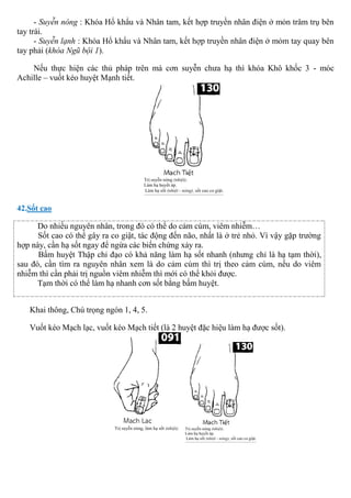 - Suyễn nóng : Khóa Hổ khẩu và Nhân tam, kết hợp truyền nhân điện ở mỏn trâm trụ bên
tay trái.
- Suyễn lạnh : Khóa Hổ khẩu và Nhân tam, kết hợp truyền nhân điện ở mỏm tay quay bên
tay phải (khóa Ngũ bội 1).
Nếu thực hiện các thủ pháp trên mà cơn suyễn chưa hạ thì khóa Khô khốc 3 - móc
Achille – vuốt kéo huyệt Mạnh tiết.
42.Sốt cao
Do nhiều nguyên nhân, trong đó có thể do cảm cúm, viêm nhiễm…
Sốt cao có thể gây ra co giật, tác động đến não, nhất là ở trẻ nhỏ. Vì vậy gặp trường
hợp này, cần hạ sốt ngay để ngừa các biến chứng xảy ra.
Bấm huyệt Thập chỉ đạo có khả năng làm hạ sốt nhanh (nhưng chỉ là hạ tạm thời),
sau đó, cần tìm ra nguyên nhân xem là do cảm cúm thì trị theo cảm cúm, nếu do viêm
nhiễm thì cần phải trị nguồn viêm nhiễm thì mới có thể khỏi được.
Tạm thời có thể làm hạ nhanh cơn sốt bằng bấm huyệt.
Khai thông, Chú trọng ngón 1, 4, 5.
Vuốt kéo Mạch lạc, vuốt kéo Mạch tiết (là 2 huyệt đặc hiệu làm hạ được sốt).
 