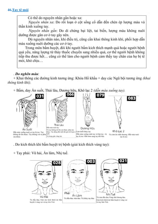 46.Tay tê mỏi
Có thể do nguyên nhân gần hoặc xa:
Nguyên nhân xa: Do rối loạn ở cột sống cổ dẫn đến chèn ép lượng máu và
thần kinh xuống tay.
Nguyên nhân gần: Do di chứng bại liệt, tai biến, lượng máu không nuôi
dưỡng được gân cơ ở tay gây nên.
Dù nguyên nhân nào, khi điều trị, cũng cần khai thông kinh khí, phối hợp dẫn
máu xuống nuôi dưỡng các cơ ở tay.
Trong môn bấm huyệt, đôi khi người bấm kích thích mạnh quá hoặc người bệnh
quá yếu, năng lượng từ thày thuốc chuyển sang nhiều quá, cơ thể người bệnh không
tiếp thu được hết… cũng có thể làm cho người bệnh cảm thấy tay chân của họ bị tê
mỏi, khó chịu…
. Do nghẽn máu:
+ Khai thông các đường kinh tương ứng: Khóa Hổ khẩu + day các Ngũ bội tương ứng (khai
thông kinh khí).
+ Bấm, day Ấn suốt, Thái lâu, Dương hữu, Khô lạc 2 (dẫn máu xuống tay).
. Do kích thích khi bấm huyệt trị bệnh (giải kích thích vùng tay):
+ Tay phải: Vũ hải, Ấn lâm, Nhị tuế.
 