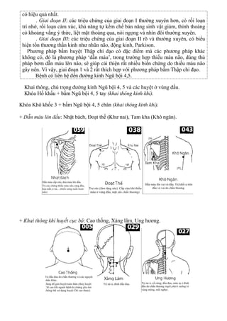 có hiệu quả nhất.
. Giai đoạn II: các triệu chứng của giai đoạn I thường xuyên hơn, có rối loạn
trí nhớ, rối loạn cảm xúc, khả năng tự kềm chế bản năng sinh vật giảm, thỉnh thoảng
có khoảng vắng ý thức, liệt mặt thoáng qua, nói ngọng và nhìn đôi thường xuyên.
. Giai đoạn III: các triệu chứng của giai đoạn II rõ và thường xuyên, có biểu
hiện tổn thương thần kinh như nhũn não, động kinh, Parkison.
Phương pháp bấm huyệt Thập chỉ đạo có đặc điểm mà các phương pháp khác
không có, đó là phương pháp ‘dẫn máu’, trong trường hợp thiếu máu não, dùng thủ
pháp bơm dẫn máu lên não, sẽ giúp cải thiện rất nhiều biến chứng do thiếu máu não
gây nên. Vì vậy, giai đoạn 1 và 2 rất thích hợp với phương pháp bấm Thập chỉ đạo.
Bệnh có liên hệ đến đường kinh Ngũ bội 4,5.
Khai thông, chú trọng đường kinh Ngũ bội 4, 5 và các huyệt ở vùng đầu.
Khóa Hổ khẩu + bấm Ngũ bội 4, 5 tay (khai thông kinh khí).
Khóa Khô khốc 3 + bấm Ngũ bội 4, 5 chân (khai thông kinh khí).
+ Dẫn máu lên đầu: Nhật bách, Đoạt thế (Khư nai), Tam kha (Khô ngân).
+ Khai thông khí huyết cục bộ: Cao thống, Xàng lâm, Ung hương.
 