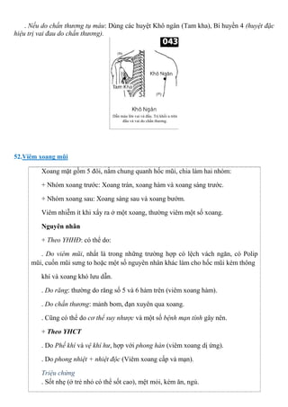 . Nếu do chấn thương tụ máu: Dùng các huyệt Khô ngân (Tam kha), Bí huyền 4 (huyệt đặc
hiệu trị vai đau do chấn thương).
52.Viêm xoang mũi
Xoang mặt gồm 5 đôi, nằm chung quanh hốc mũi, chia làm hai nhóm:
+ Nhóm xoang trước: Xoang trán, xoang hàm và xoang sàng trước.
+ Nhóm xoang sau: Xoang sàng sau và xoang bướm.
Viêm nhiễm ít khi xẩy ra ở một xoang, thường viêm một số xoang.
Nguyên nhân
+ Theo YHHĐ: có thể do:
. Do viêm mũi, nhất là trong những trường hợp có lệch vách ngăn, có Polip
mũi, cuốn mũi sưng to hoặc một số nguyên nhân khác làm cho hốc mũi kém thông
khí và xoang khó lưu dẫn.
. Do răng: thường do răng số 5 và 6 hàm trên (viêm xoang hàm).
. Do chấn thương: mảnh bom, đạn xuyên qua xoang.
. Cũng có thể do cơ thể suy nhược và một số bệnh mạn tính gây nên.
+ Theo YHCT
. Do Phế khí và vệ khí hư, hợp với phong hàn (viêm xoang dị ứng).
. Do phong nhiệt + nhiệt độc (Viêm xoang cấp và mạn).
Triệu chứng
. Sốt nhẹ (ở trẻ nhỏ có thể sốt cao), mệt mỏi, kém ăn, ngủ.
 