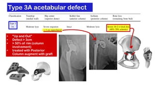 Total Hip Arthroplasty ( THA ) Revision | PDF