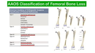 Total Hip Arthroplasty ( THA ) Revision | PDF