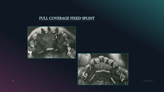 Permanent Splints Periodontal splinting | PPTX