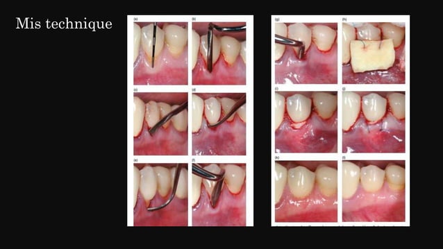 Minimally invasive periodontal surgery | PPTX | First Aid | Injuries