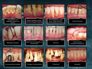 Chronic periodontitis | PPTX