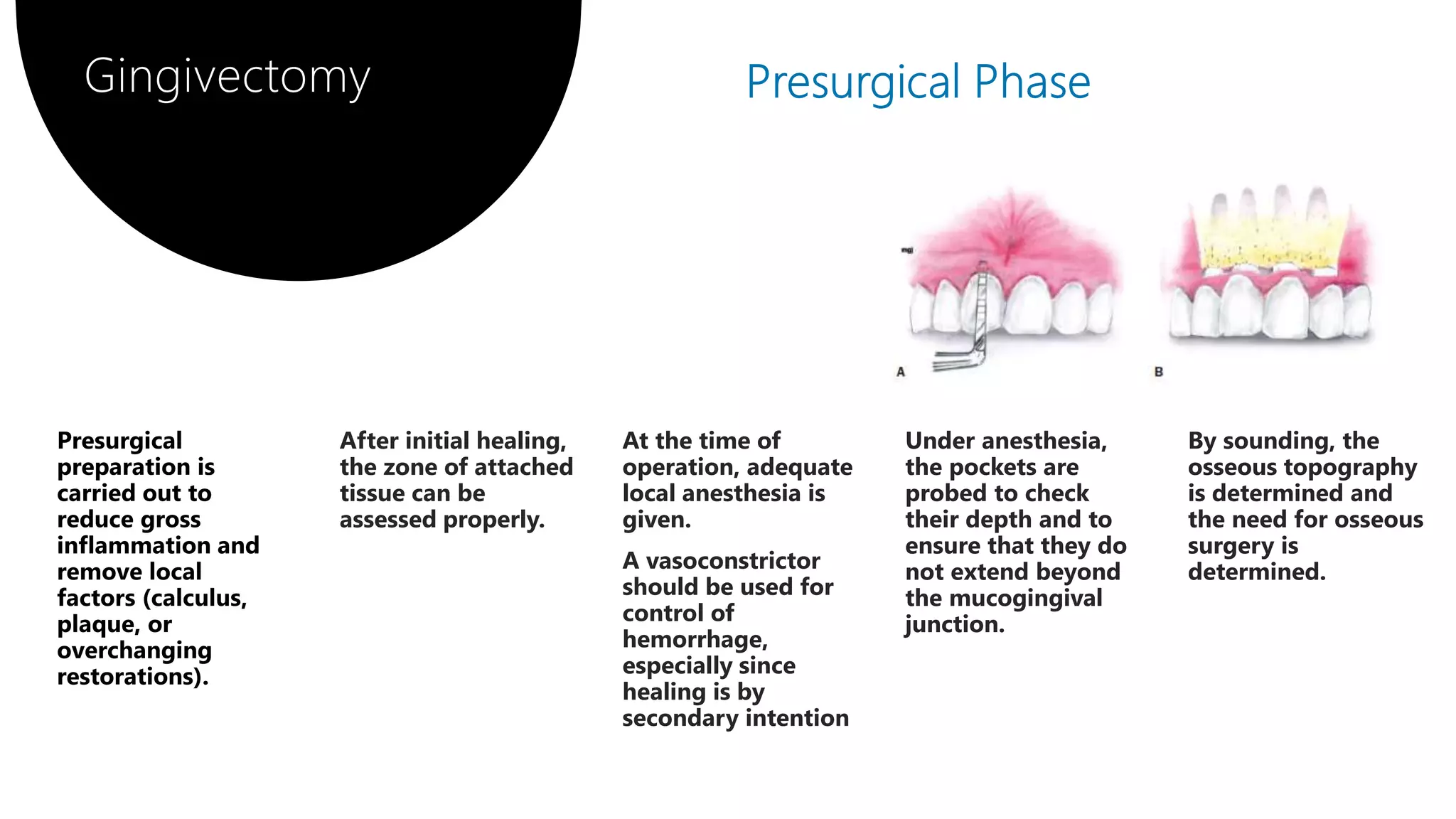 Gingival surgical techniques/Gingivectomy | PPTX