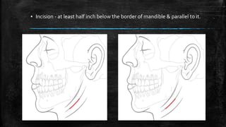 ▪ Incision - at least half inch below the border of mandible & parallel to it.
 