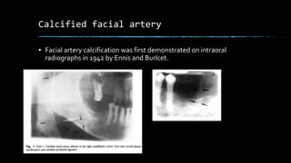Calcified facial artery
▪ Facial artery calcification was first demonstrated on intraoral
radiographs in 1942 by Ennis and BurIcet.
 