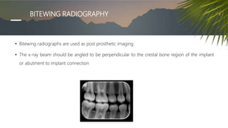 BITEWING RADIOGRAPHY
• Bitewing radiographs are used as post prosthetic imaging.
• The x-ray beam should be angled to be perpendicular to the crestal bone region of the implant
or abutment to implant connection
 