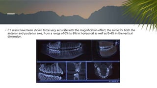 • CT scans have been shown to be very accurate with the magnification effect, the same for both the
anterior and posterior area, from a range of 0% to 6% in horizontal as well as 0-4% in the vertical
dimension.
 