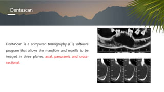 Dentascan
DentaScan is a computed tomography (CT) software
program that allows the mandible and maxilla to be
imaged in three planes: axial, panoramic and cross-
sectional.
 