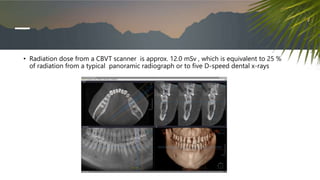 • Radiation dose from a CBVT scanner is approx. 12.0 mSv , which is equivalent to 25 %
of radiation from a typical panoramic radiograph or to five D-speed dental x-rays
 