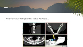 It helps to measure the length and the width of the alveolus…..
 