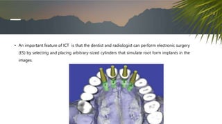 • An important feature of ICT is that the dentist and radiologist can perform electronic surgery
(ES) by selecting and placing arbitrary-sized cylinders that simulate root form implants in the
images.
 