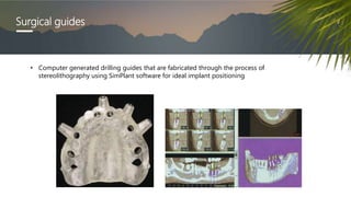 Surgical guides
• Computer generated drilling guides that are fabricated through the process of
stereolithography using SimPlant software for ideal implant positioning
 
