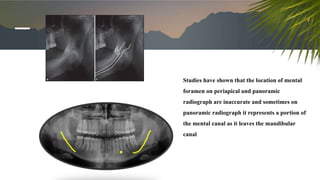Studies have shown that the location of mental
foramen on periapical and panoramic
radiograph are inaccurate and sometimes on
panoramic radiograph it represents a portion of
the mental canal as it leaves the mandibular
canal
 