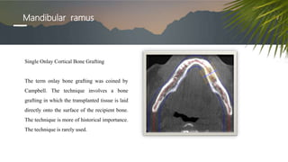 Mandibular ramus
Single Onlay Cortical Bone Grafting
The term onlay bone grafting was coined by
Campbell. The technique involves a bone
grafting in which the transplanted tissue is laid
directly onto the surface of the recipient bone.
The technique is more of historical importance.
The technique is rarely used.
 