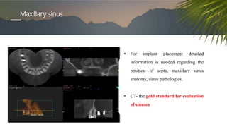 Maxillary sinus
• For implant placement detailed
information is needed regarding the
position of septa, maxillary sinus
anatomy, sinus pathologies.
• CT- the gold standard for evaluation
of sinuses
 