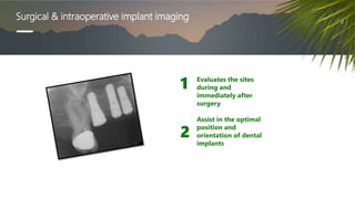 Surgical & intraoperative implant imaging
Evaluates the sites
during and
immediately after
surgery
Assist in the optimal
position and
orientation of dental
implants
1
2
 