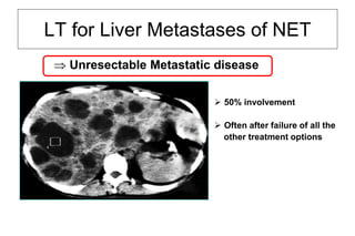 LT for Liver Metastases of NET
 Unresectable Metastatic disease
 50% involvement
 Often after failure of all the
other treatment options
 