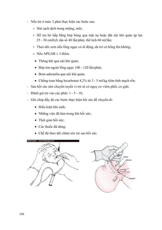 104
- Nếu trẻ ở mức 2 phải thực hiện các bước sau:
Hút sạch dịch trong miệng, mũi;
Hỗ trợ hô hấp bằng bóp bóng qua mặt nạ hoặc đặt nội khí quản áp lực
25 - 30 cmH20, tần số 40 lần/phút, thể tích 60 ml/lần;
Theo dõi xem nếu lồng ngực có di động, da trẻ có hồng lên không;
Nếu APGAR 3 điểm.
Thông khí qua nội khí quản;
Bóp tim ngoài lồng ngực 100 - 120 lần/phút;
Bơm adrenalin qua nội khí quản;
Chống toan bằng bicarbonat 4,2% từ 3 - 5 ml/kg tiêm tĩnh mạch rốn.
- Sau hồi sức nên chuyển tuyến vì trẻ sẽ có nguy cơ viêm phổi, co giật;
- Đánh giá trẻ vào các phút: 1 - 5 - 10;
- Ghi chép đầy đủ các bước thực hiện hồi sức để chuyển đi:
Điều kiện khi sinh;
Những việc đã làm trong khi hồi sức;
Thời gian hồi sức;
Các thuốc đã dùng;
Chế độ theo dõi chăm sóc trẻ sau hồi sức.
 