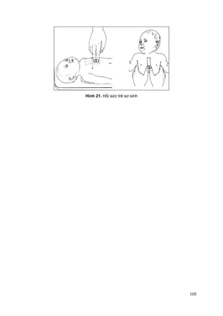 105
Hình 21. Hồi sức trẻ sơ sinh
 