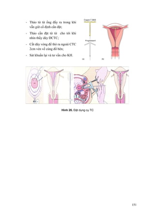 151
- Tháo từ từ ống đẩy ra trong khi
vẫn giữ cố định cần đặt;
- Tháo cần đặt từ từ cho tới khi
nhìn thấy dây DCTC;
- Cắt dây vòng để thò ra ngoài CTC
2cm vén về cùng đồ bên;
- Sát khuẩn lại và tư vấn cho KH.
Hình 26. Đặt dụng cụ TC
 