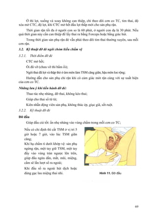 69
Ở thì lọt, xuống và xoay không can thiệp, chỉ theo dõi cơn co TC, tim thai, độ
xóa mở CTC, độ lọt, khi CTC mở hết đầu lọt thấp mới cho sản phụ rặn.
Thời gian rặn tối đa ở người con so là 60 phút, ở người con dạ là 30 phút. Nếu
quá thời gian này cần can thiệp để lấy thai ra bằng Forceps hoặc bằng giác hút.
Trong thời gian sản phụ rặn đẻ vẫn phải theo dõi tim thai thường xuyên, sau mỗi
cơn rặn.
3.2. Kỹ thuật đỡ đẻ ngôi chỏm kiểu chẩm vệ
3.2.1. Thời điểm đỡ đẻ
CTC mở hết;
Ối đã vỡ (chưa vỡ thì bấm ối);
Ngôi thai đã lọt và thập thò ở âm môn làm TSM căng giãn, hậu môn loe rộng;
Hướng dẫn cho sản phụ chỉ rặn khi có cảm giác mót rặn cùng với sự xuất hiện
của cơn co TC.
Những lƣu ý khi tiến hành đỡ đẻ:
Thao tác nhẹ nhàng, đỡ thai, không kéo thai;
Giúp cho thai sổ từ từ;
Kiên nhẫn động viên sản phụ, không thúc ép, giục giã, sốt ruột.
3.2.2. Kỹ thuật đỡ đẻ
Đỡ đầu
Giúp đầu cúi tốt: ấn nhẹ nhàng vào vùng chẩm trong mỗi cơn co TC;
Nếu có chỉ định thì cắt TSM ở vị trí 5
giờ hoặc 7 giờ, vào lúc TSM giãn
căng;
Khi hạ chẩm tì dưới khớp vệ: sản phụ
ngừng rặn, một tay giữ TSM, một tay
đẩy vào vùng trán ngược lên trên,
giúp đầu ngửa dần, mắt, mũi, miệng,
cằm sẽ lần lượt sổ ra ngoài;
Khi đầu sổ ra ngoài hút dịch hoặc
dùng gạc lau miệng thai nhi. Hình 11. Đỡ đầu
 