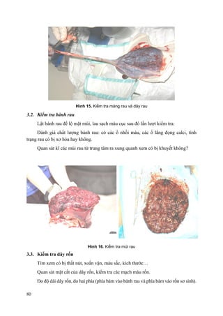80
Hình 15. Kiểm tra màng rau và dây rau
3.2. Kiểm tra bánh rau
Lật bánh rau để lộ mặt múi, lau sạch máu cục sau đó lần lượt kiểm tra:
Đánh giá chất lượng bánh rau: có các ổ nhồi máu, các ổ lắng đọng calci, tình
trạng rau có bị xơ hóa hay không.
Quan sát kĩ các múi rau từ trung tâm ra xung quanh xem có bị khuyết không?
Hình 16. Kiểm tra múi rau
3.3. Kiểm tra dây rốn
Tìm xem có bị thắt nút, xoắn vặn, màu sắc, kích thước…
Quan sát mặt cắt của dây rốn, kiểm tra các mạch máu rốn.
Đo độ dài dây rốn, đo hai phía (phía bám vào bánh rau và phía bám vào rốn sơ sinh).
 