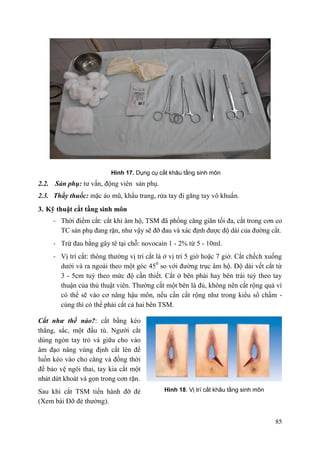 85
Hình 17. Dụng cụ cắt khâu tầng sinh môn
2.2. Sản phụ: tư vấn, động viên sản phụ.
2.3. Thầy thuốc: mặc áo mũ, khẩu trang, rửa tay đi găng tay vô khuẩn.
3. Kỹ thuật cắt tầng sinh môn
- Thời điểm cắt: cắt khi âm hộ, TSM đã phồng căng giãn tối đa, cắt trong cơn co
TC sản phụ đang rặn, như vậy sẽ đỡ đau và xác định được độ dài của đường cắt.
- Trừ đau bằng gây tê tại chỗ: novocain 1 - 2% từ 5 - 10ml.
- Vị trí cắt: thông thường vị trí cắt là ở vị trí 5 giờ hoặc 7 giờ. Cắt chếch xuống
dưới và ra ngoài theo một góc 450
so với đường trục âm hộ. Độ dài vết cắt từ
3 - 5cm tuỳ theo mức độ cần thiết. Cắt ở bên phải hay bên trái tuỳ theo tay
thuận của thủ thuật viên. Thường cắt một bên là đủ, không nên cắt rộng quá vì
có thể sẽ vào cơ nâng hậu môn, nếu cần cắt rộng như trong kiểu sổ chẩm -
cùng thì có thể phải cắt cả hai bên TSM.
Cắt nhƣ thế nào?: cắt bằng kéo
thẳng, sắc, một đầu tù. Người cắt
dùng ngón tay trỏ và giữa cho vào
âm đạo nâng vùng định cắt lên để
luồn kéo vào cho căng và đồng thời
để bảo vệ ngôi thai, tay kia cắt một
nhát dứt khoát và gọn trong cơn rặn.
Sau khi cắt TSM tiến hành đỡ đẻ
(Xem bài Đỡ đẻ thường).
Hình 18. Vị trí cắt khâu tầng sinh môn
 
