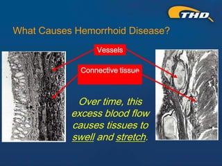 Thd Operation THD Procedure for Hemorrhoids: A Kinder, Gentler Approach - Presented ...