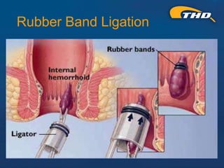 Thd Operation THD Procedure for Hemorrhoids: A Kinder, Gentler Approach - Presented ...