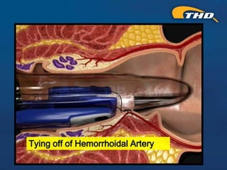 Thd Operation THD Procedure for Hemorrhoids: A Kinder, Gentler Approach - Presented ...