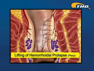Thd Operation THD Procedure for Hemorrhoids: A Kinder, Gentler Approach - Presented ...