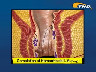 Thd Operation THD Procedure for Hemorrhoids: A Kinder, Gentler Approach - Presented ...
