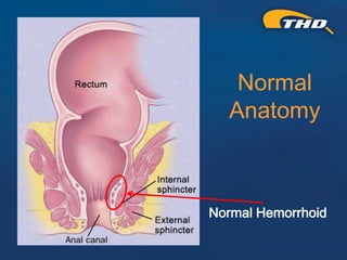 Thd Operation THD Procedure for Hemorrhoids: A Kinder, Gentler Approach - Presented ...