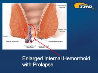 Thd Operation THD Procedure for Hemorrhoids: A Kinder, Gentler Approach - Presented ...