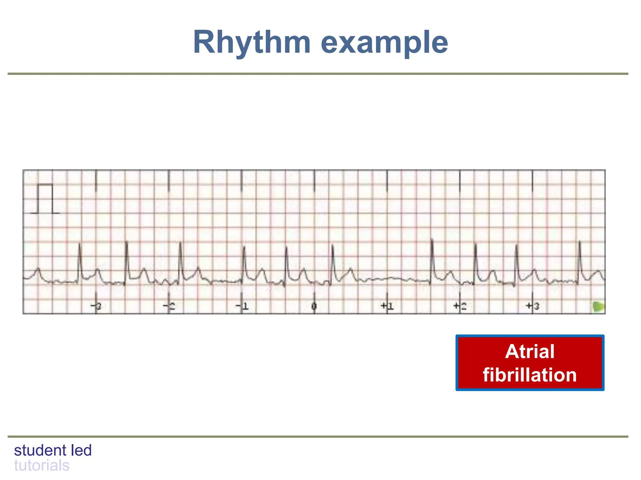 student led
tutorials
Rhythm example
Atrial
fibrillation
 