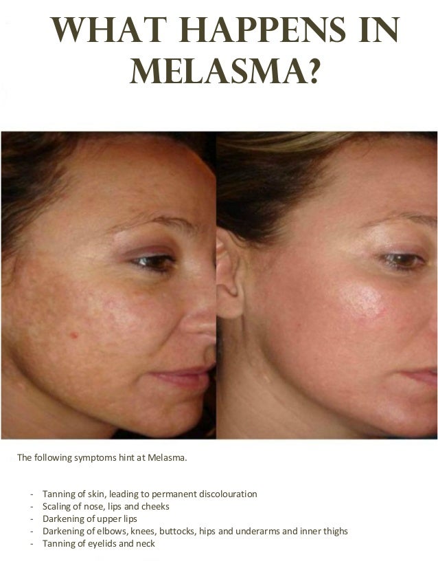 What is the best treatment for melasma?