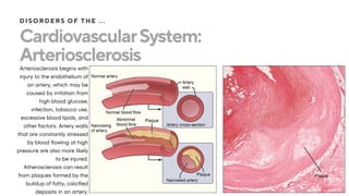 CardiovascularSystem:
Arteriosclerosis
Arteriosclerosis begins with
injury to the endothelium of
an artery, which may be
caused by irritation from
high blood glucose,
infection, tobacco use,
excessive blood lipids, and
other factors. Artery walls
that are constantly stressed
by blood flowing at high
pressure are also more likely
to be injured.
Atherosclerosis can result
from plaques formed by the
buildup of fatty, calcified
deposits in an artery.
DISORDERS OF THE ...
 