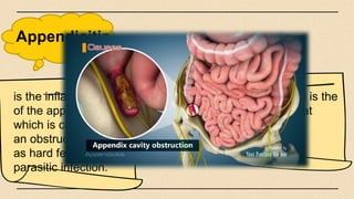 Appendicitis
Surgical removal is the
best option to teat
appendicitis.
is the inflammation
of the appendix,
which is caused by
an obstruction, such
as hard feces, or
parasitic infection.
 