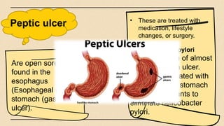 Peptic ulcer • These are treated with
medication, lifestyle
changes, or surgery.
• Helicobacter pylori
- Are the cause of almost
all the stomach ulcer.
- These are treated with
antibiotics and stomach
acid suppressants to
eliminate helicobacter
pylori.
Are open sores
found in the
esophagus
(Esophageal ulcer),
stomach (gastric
ulcer).
 