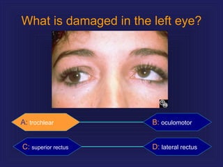 What is damaged in the left eye? A:   trochlear B:   oculomotor C:   superior rectus D:   lateral rectus A:   trochlear 