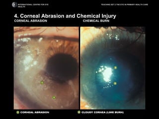 the eye in primary care | PPT