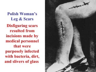 Polish Woman’s Leg & Scars Disfiguring scars resulted from incisions made by medical personnel that were purposely infected with bacteria, dirt, and slivers of glass   