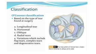 Meniscus Injury and Management PPT slides | PPTX