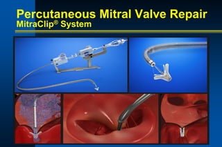 Percutaneous Mitral Valve Repair
MitraClip® System
 